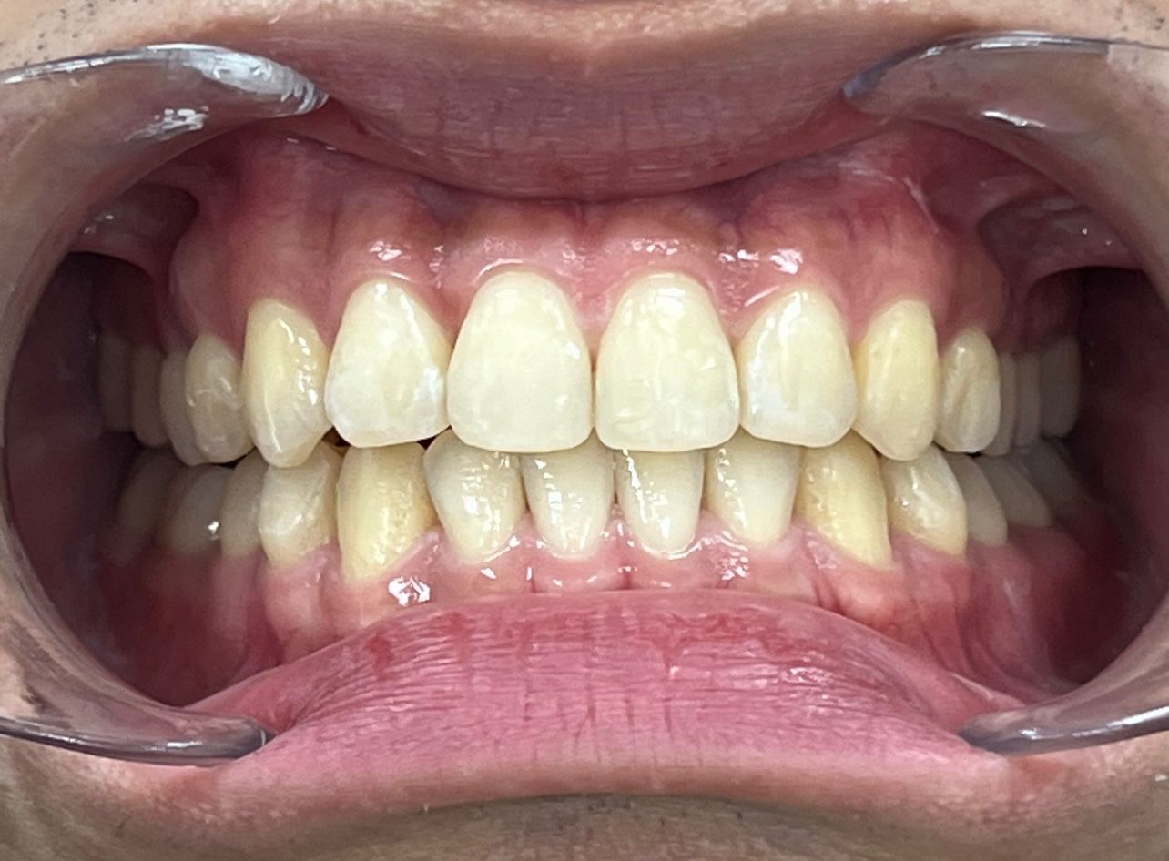 After Invisalign — Bite Realigned