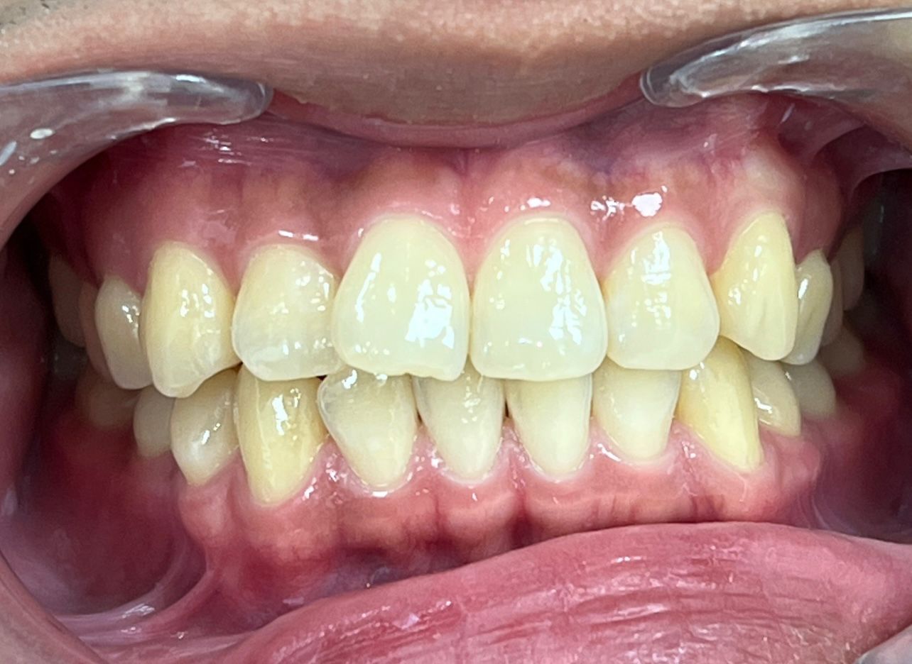 Before Invisalign — Bite Realigned