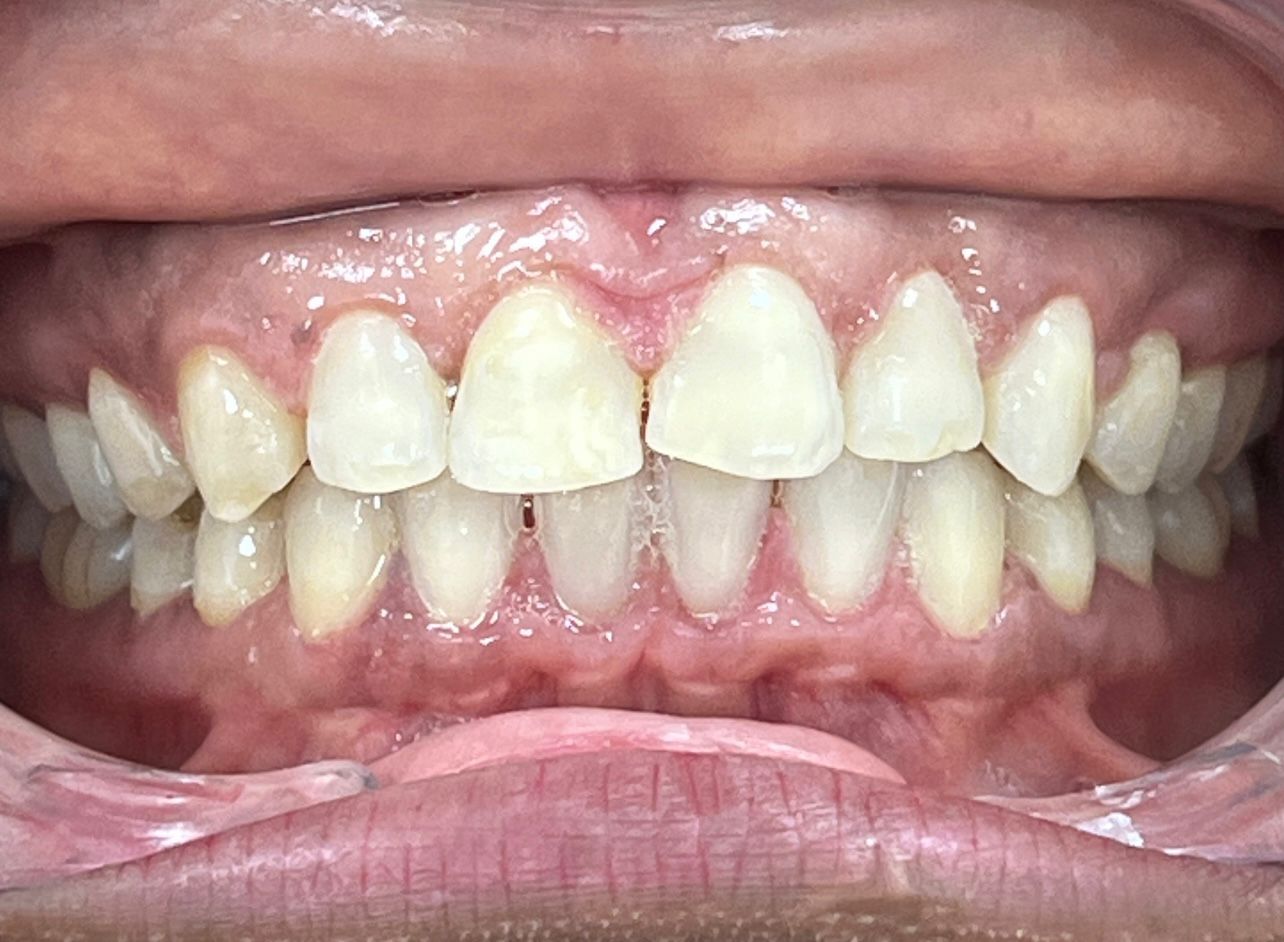After Invisalign — Gaps Closed