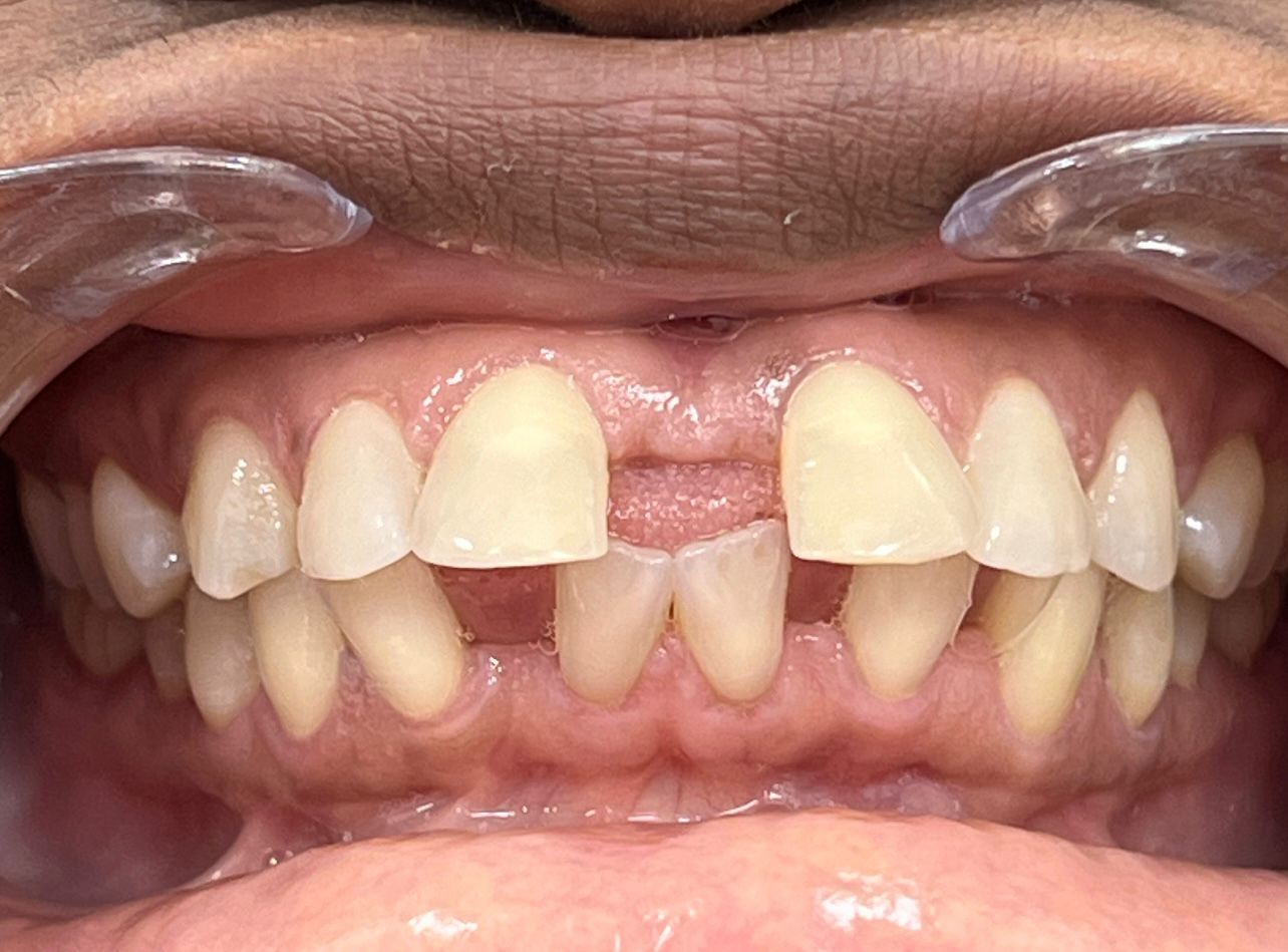 Before Invisalign — Gaps Closed