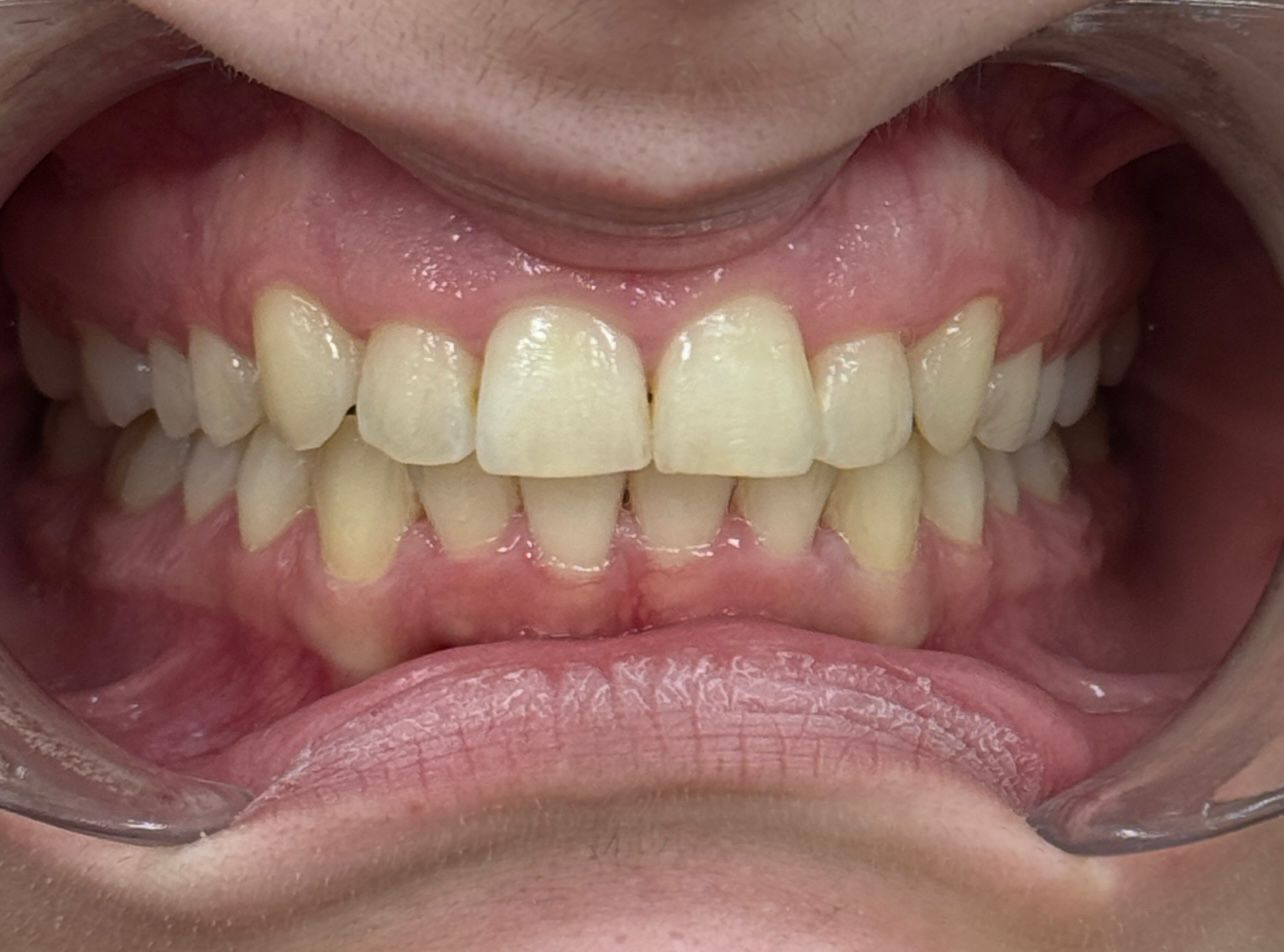 After Invisalign — Overbite Improved