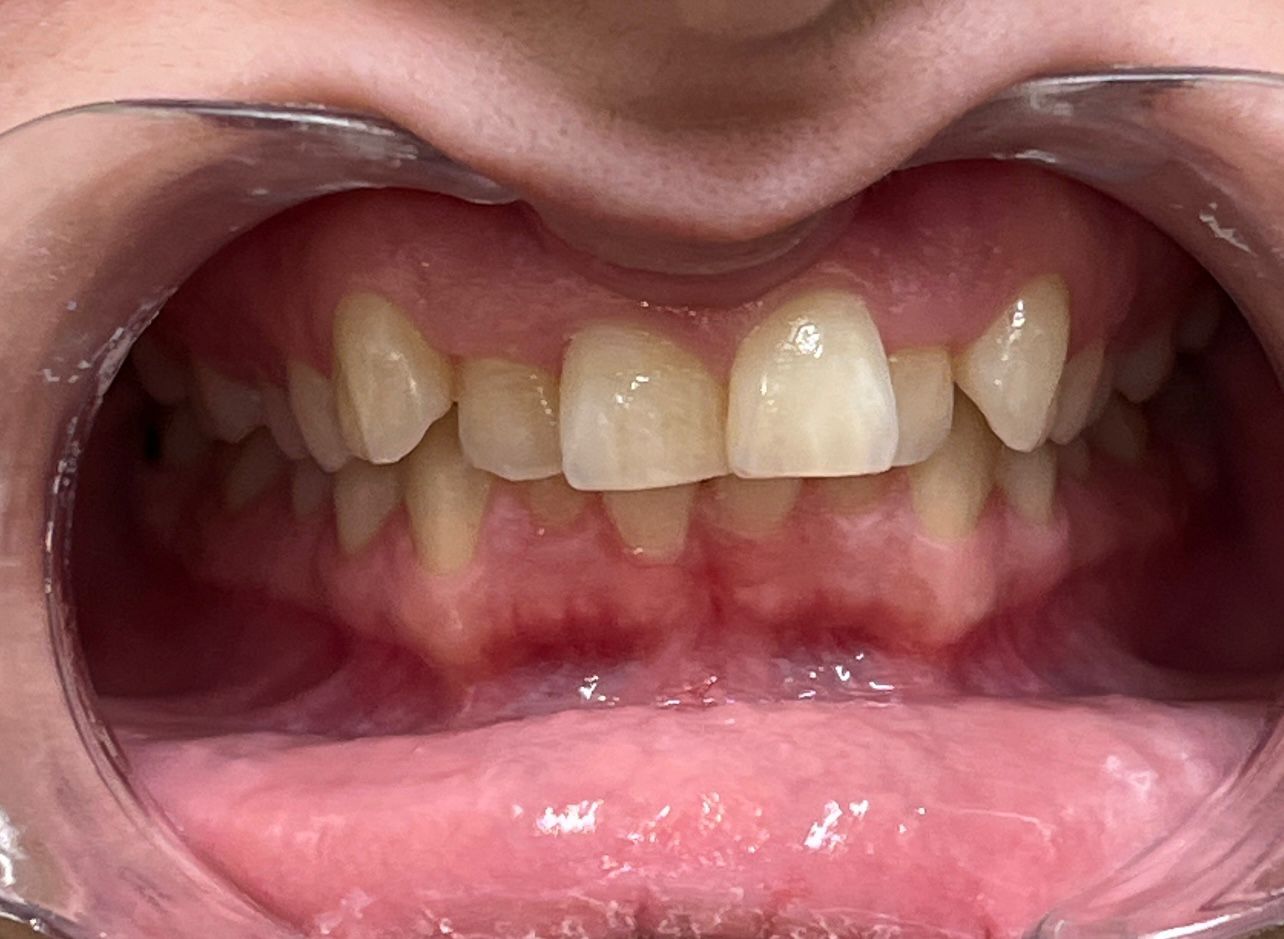 Before Invisalign — Overbite Improved