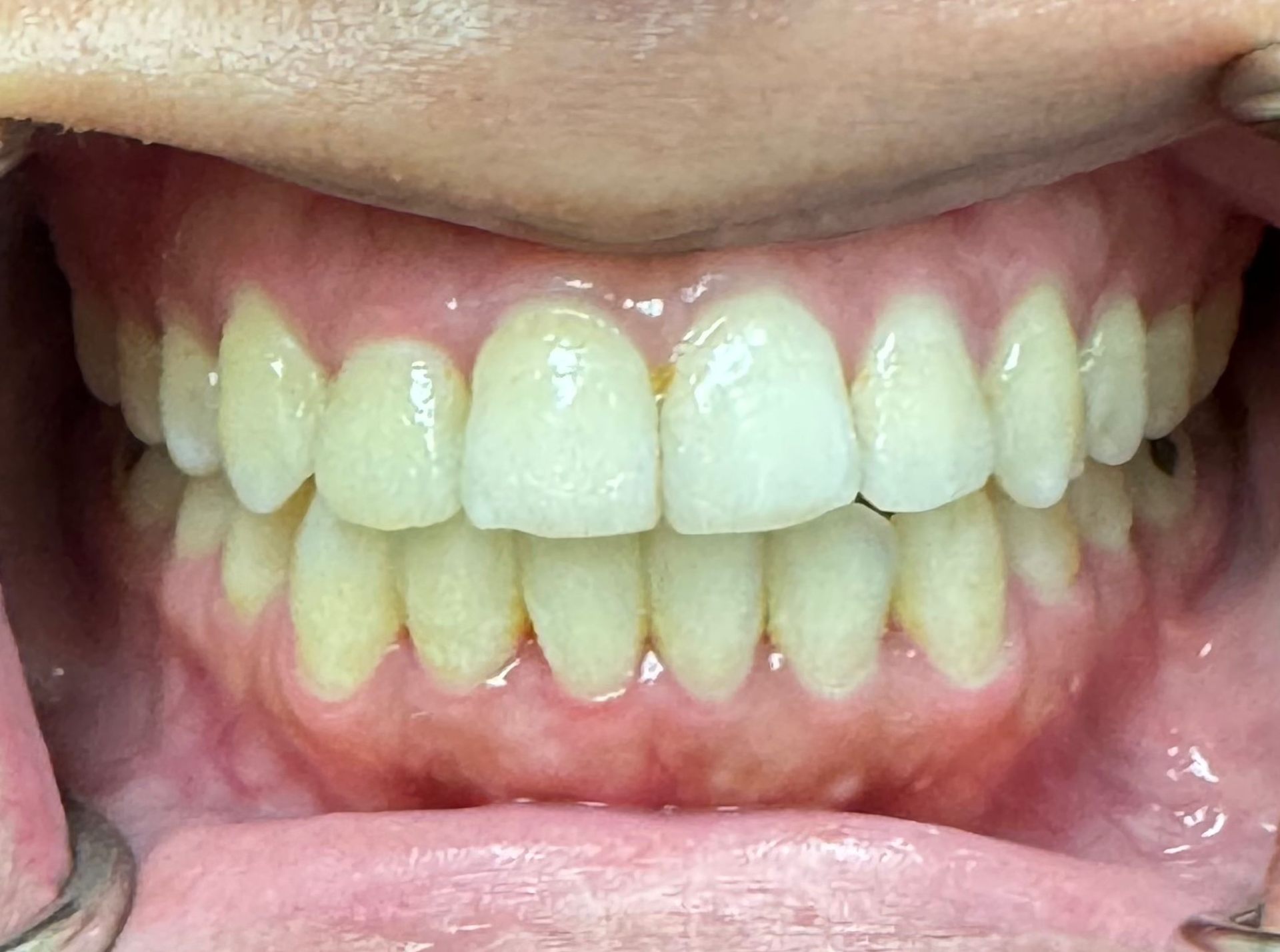 After Invisalign — Crowding Corrected