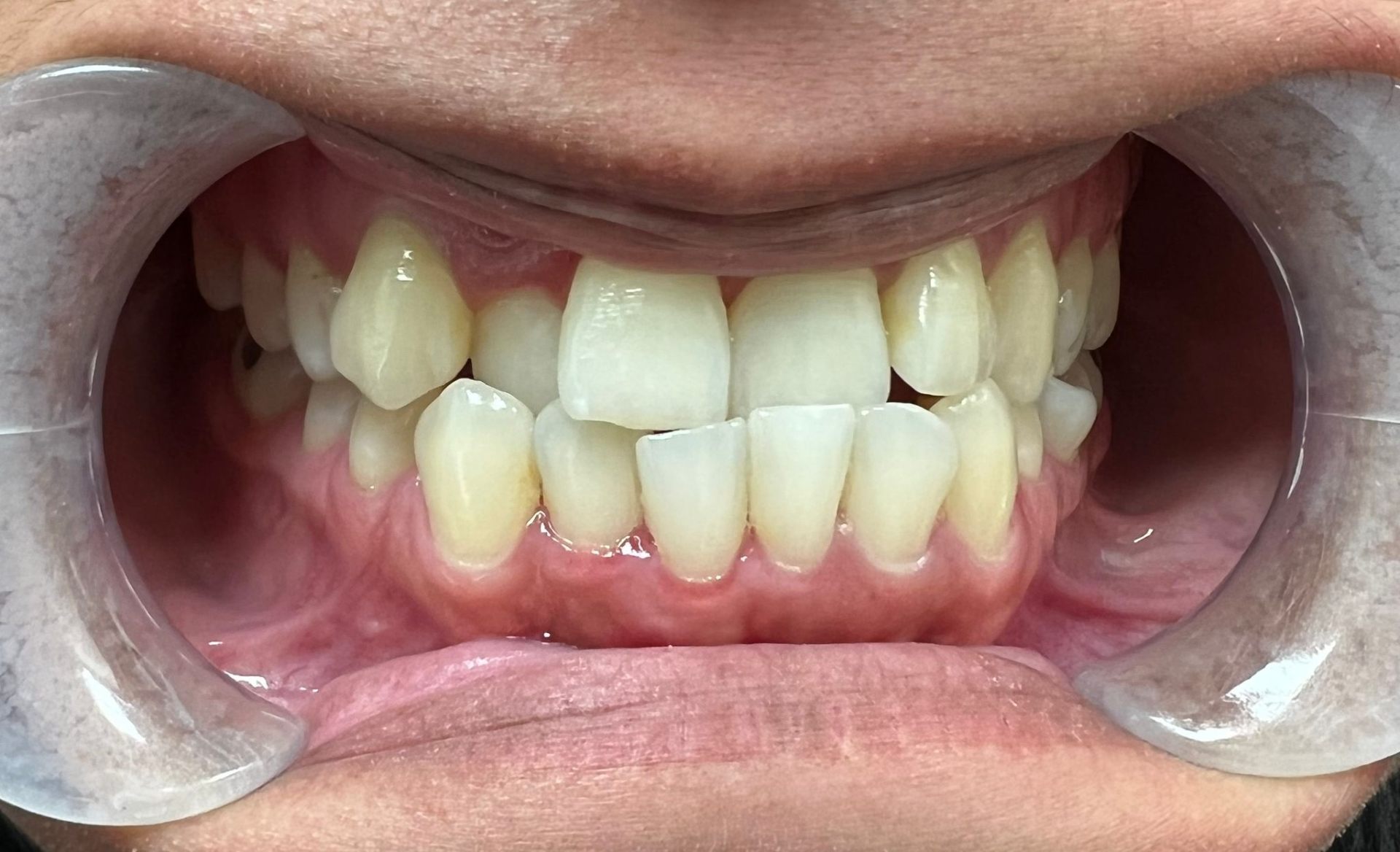 Before Invisalign — Crowding Corrected