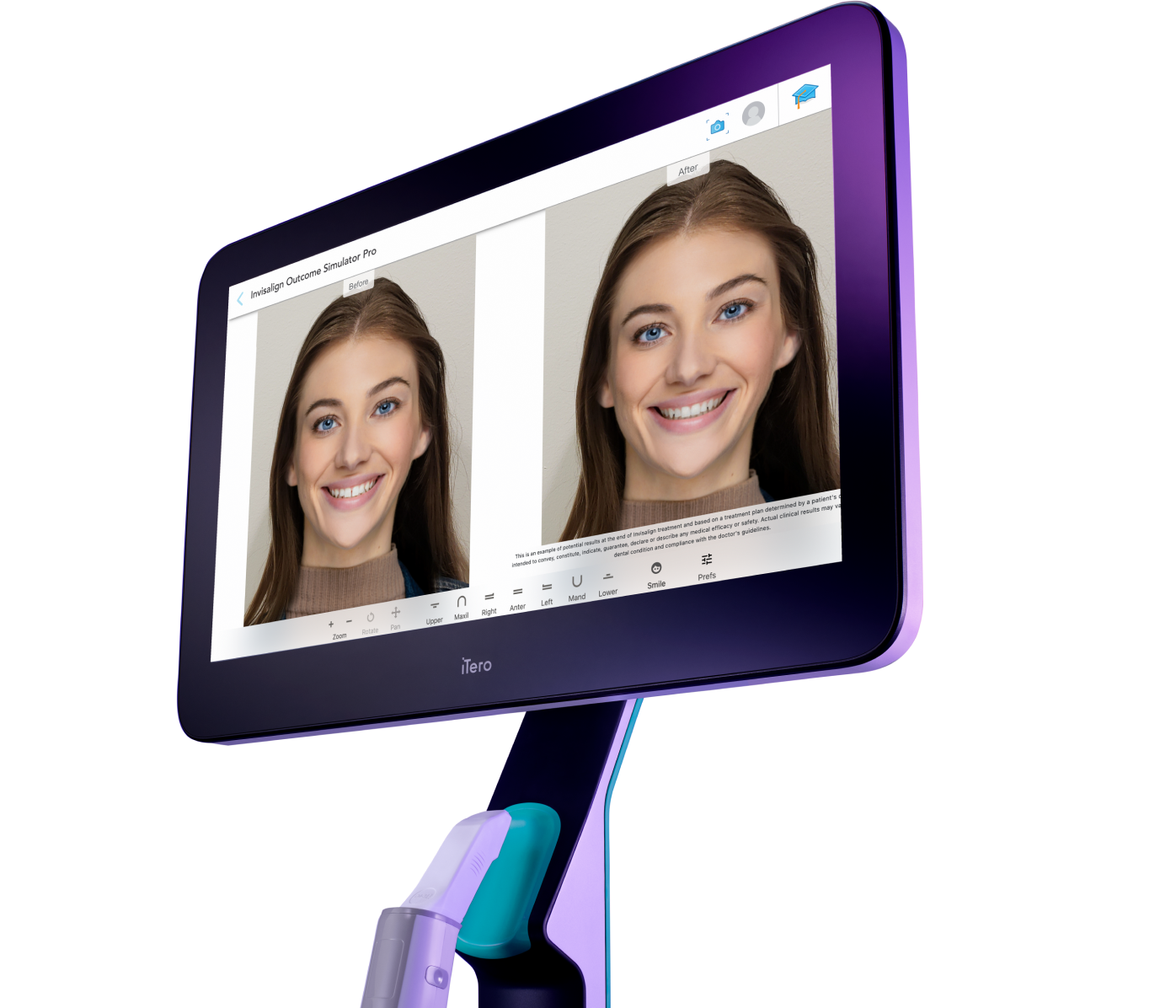 iTero intraoral scanner showing before-and-after Invisalign smile simulation